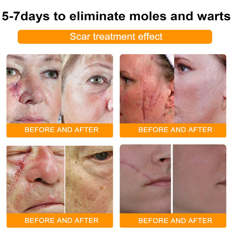 šLOVILDS⢠Bee Venom Wart & Tag Removal Cream(šØāāSuitable for all skin types)š(š„BUY 1 GET 1)