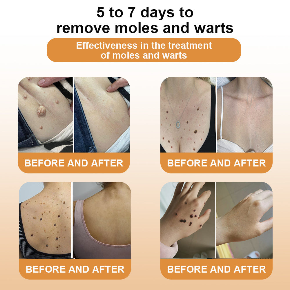 šLOVILDS⢠Bee Venom Wart & Tag Removal Cream(šØāāSuitable for all skin types)š(š„BUY 1 GET 1)