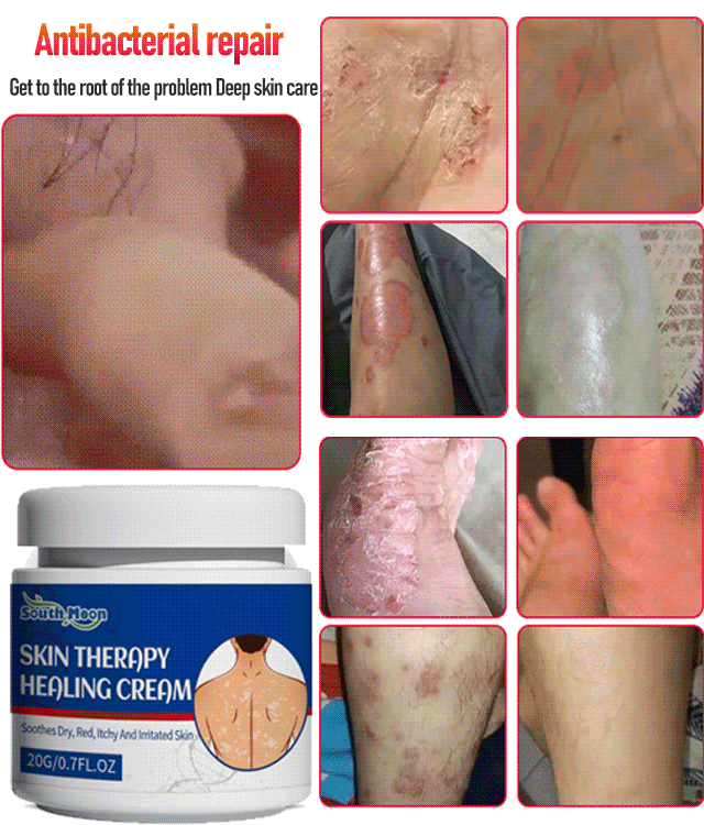 I try it and it really works !Eczema Redness Itching Relief Skin Repair Cream
