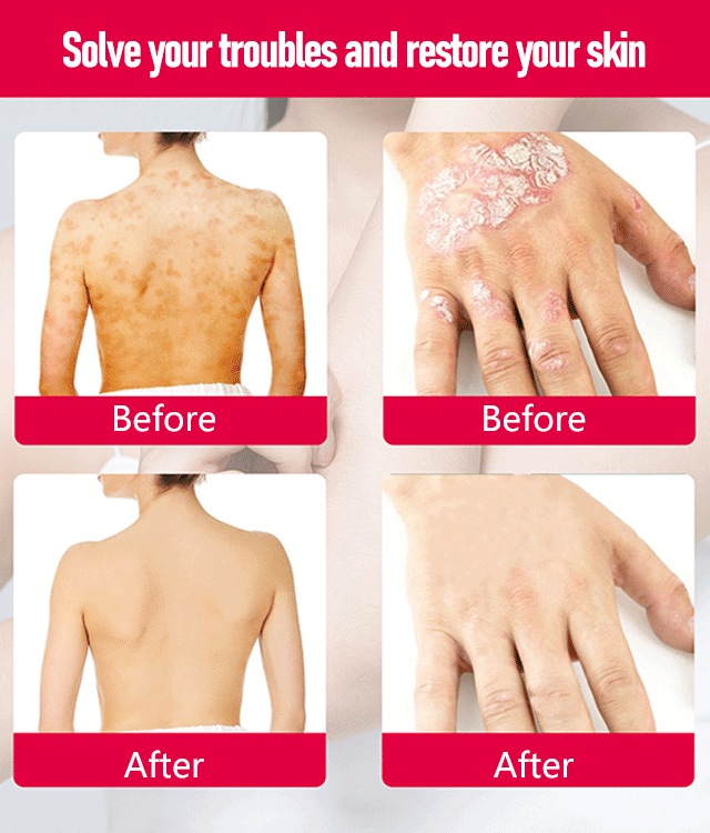 I try it and it really works !Eczema Redness Itching Relief Skin Repair Cream