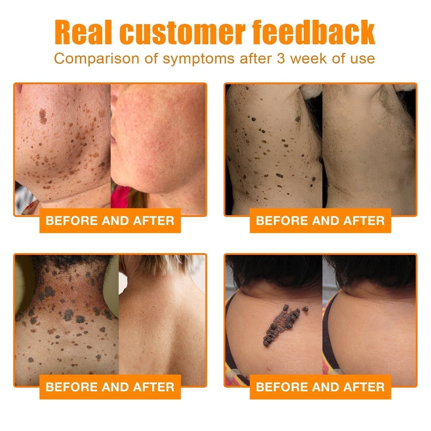 šLOVILDS⢠Bee Venom Wart & Tag Removal Cream(šØāāSuitable for all skin types)š(š„BUY 1 GET 1)