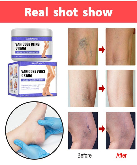 【Varicose Vein Cream】Relieve venous pain and promote blood circulation