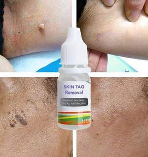 SKIN TAG REMOVER