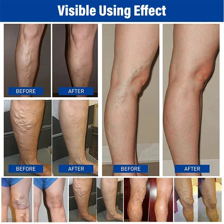 Varicose Vein Repair Cream