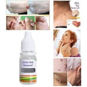 SKIN TAG REMOVER