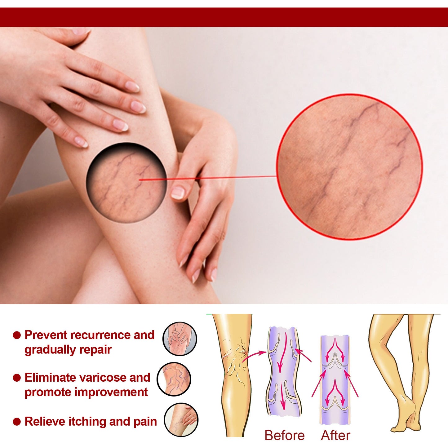 varicose veins, promoting blood【Varicose Vein Cream】