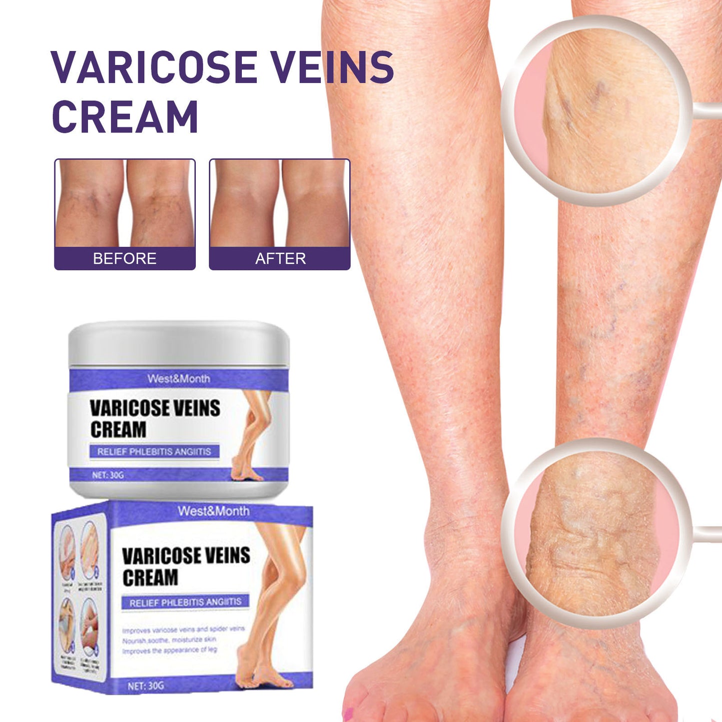 varicose veins, promoting blood【Varicose Vein Cream】