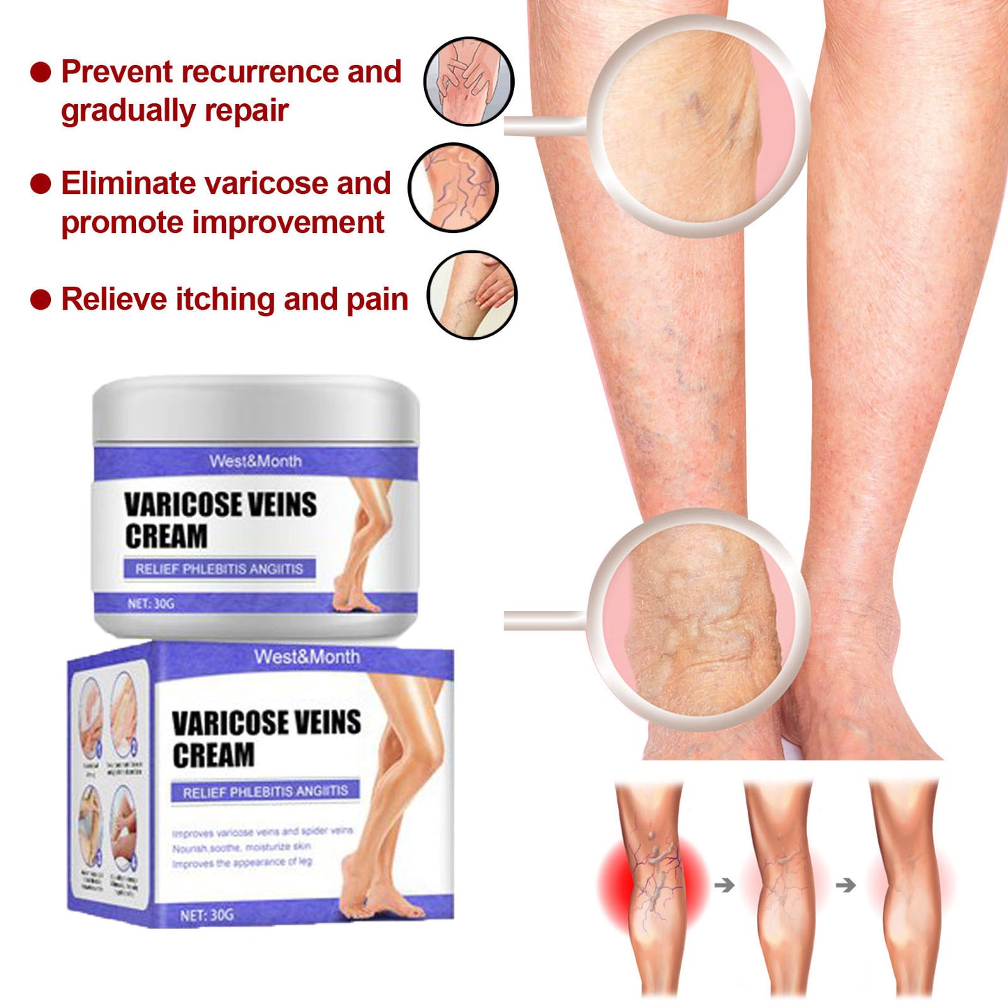 varicose veins, promoting blood【Varicose Vein Cream】