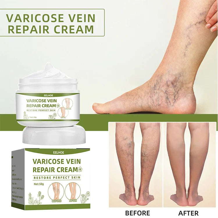 Varicose Vein Repair Cream