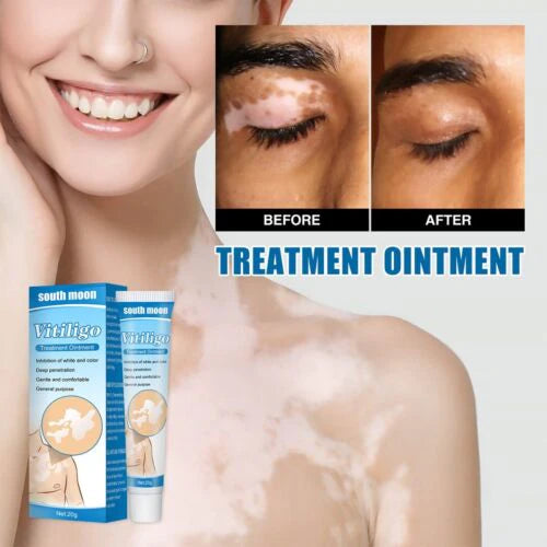 Vitiligo Cream Treatment Ointment Leukoplakia Relief Repair